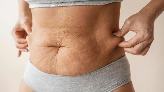 Excesso de pele após emagrecimento: por que acontece e quando a cirurgia deixa de ser estética para virar necessidade